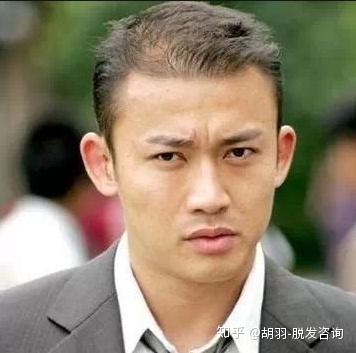 明星植發，頭頂新旅程與友情力量鑄就秀發重生