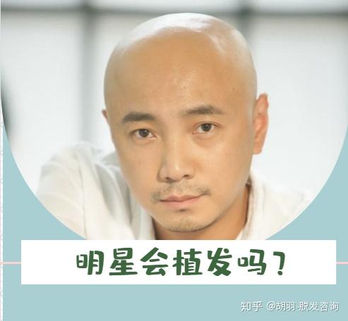 明星植發,頭頂新旅程與友情力量鑄就秀發重生