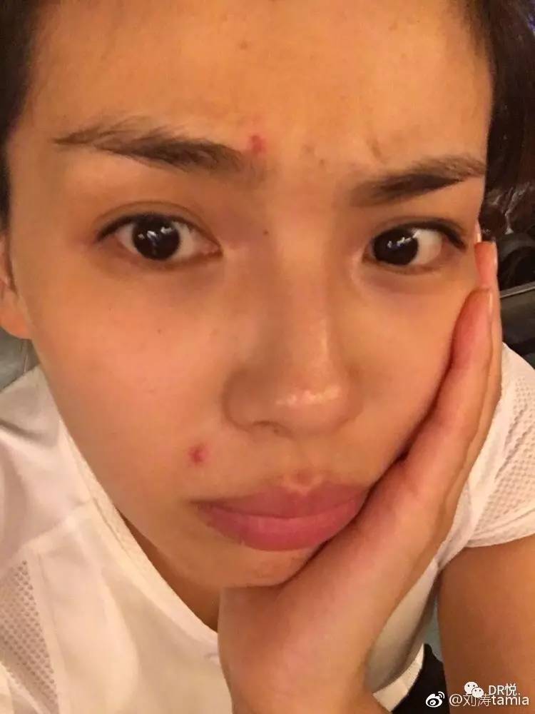 為什么明星不長痘,明星不長痘，背后的故事與真相探尋